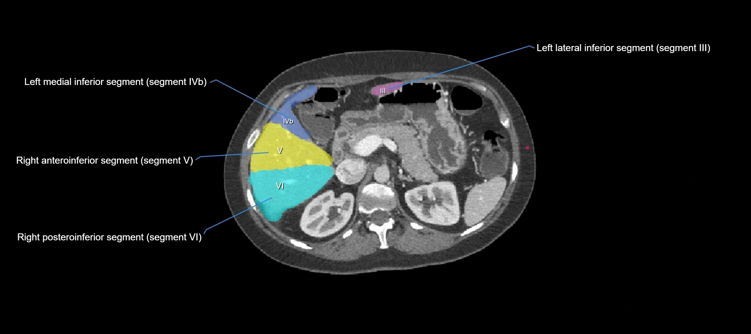 CT liver segments axial cross sectional anatomy labelled image-00036.webp